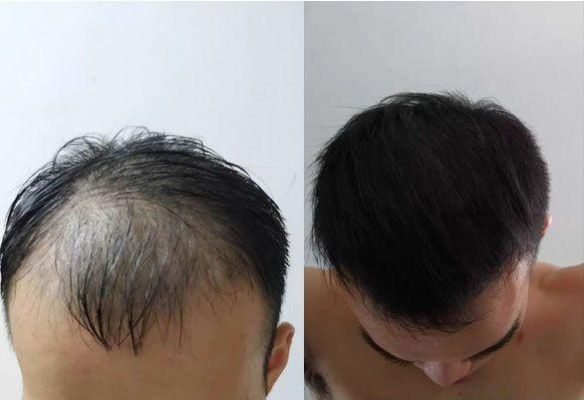 脱发是什么原因,治疗脱发最好的方法？（战地2移植的武器没子弹）