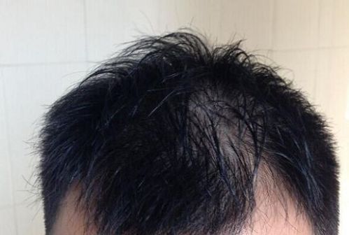 脱发是什么原因,治疗脱发最好的方法？（战地2移植的武器没子弹）