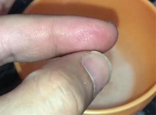 手上扎进去很小很小的刺怎么办？（武器手中刺）